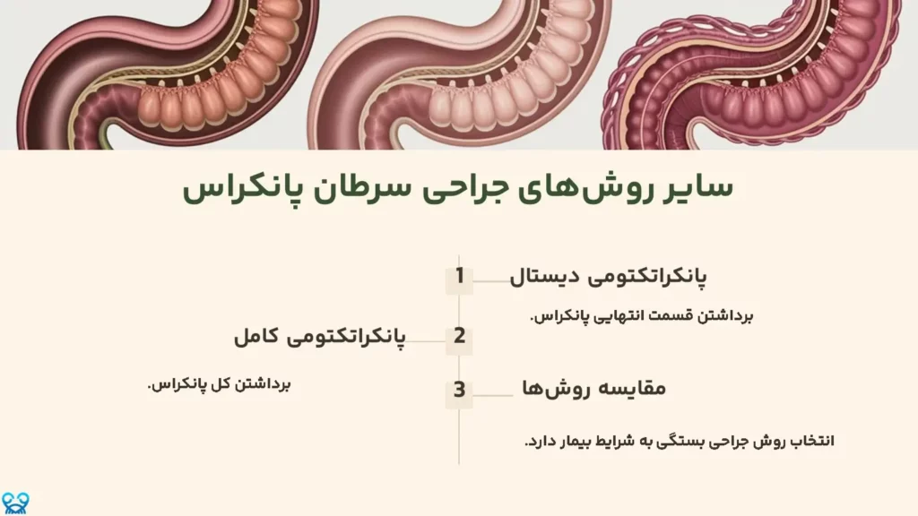 سایر روش‌های جراحی سرطان پانکراس
